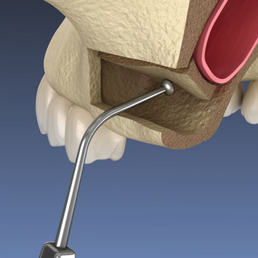 Illustration showing the sinus lift procedure