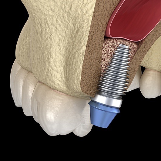 Bone Grafting Houston Tx Dental Implants Missing Teeth