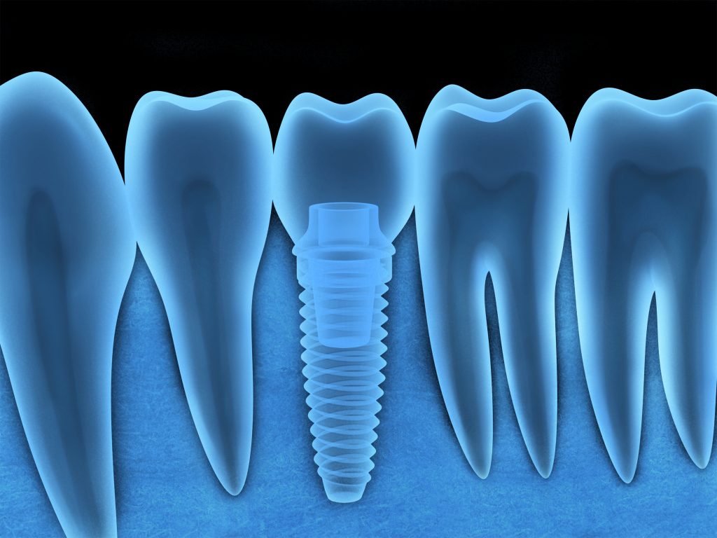 Can Stress Cause Dental Implants To Fail