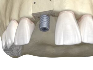 Illustration of dental implant in jawbone after bone graft