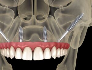 Close-up illustration of zygomatic dental implants