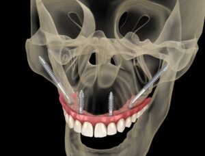 Illustration of human skull with zygomatic dental implants