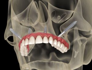 Digital illustration showing zygomatic dental implants