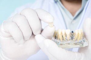 Dentist using model to explain dental implants